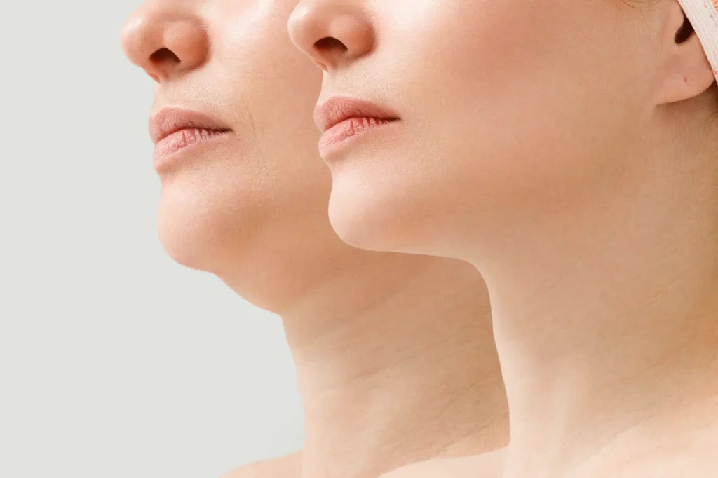 Side-by-side profiles show two views of a woman's lower face, chin, jawline, and neck.